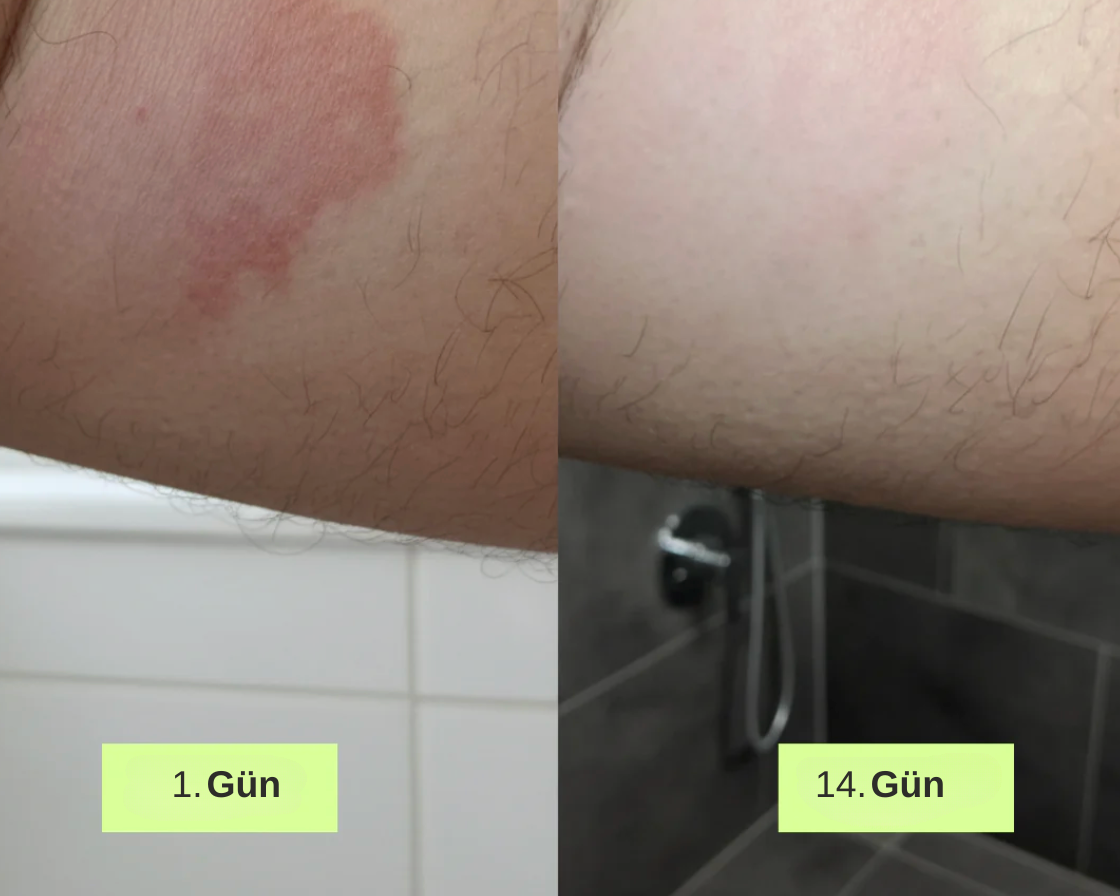 Mantar Giderici Sabun ve Özel Lif