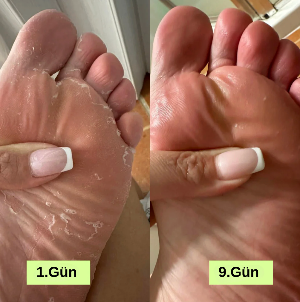 Mantar Giderici Sabun ve Özel Lif